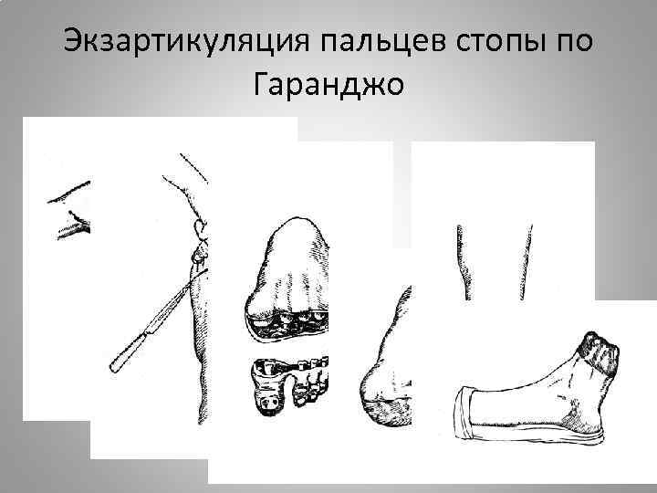 Карта вызова травматическая ампутация фаланги пальца