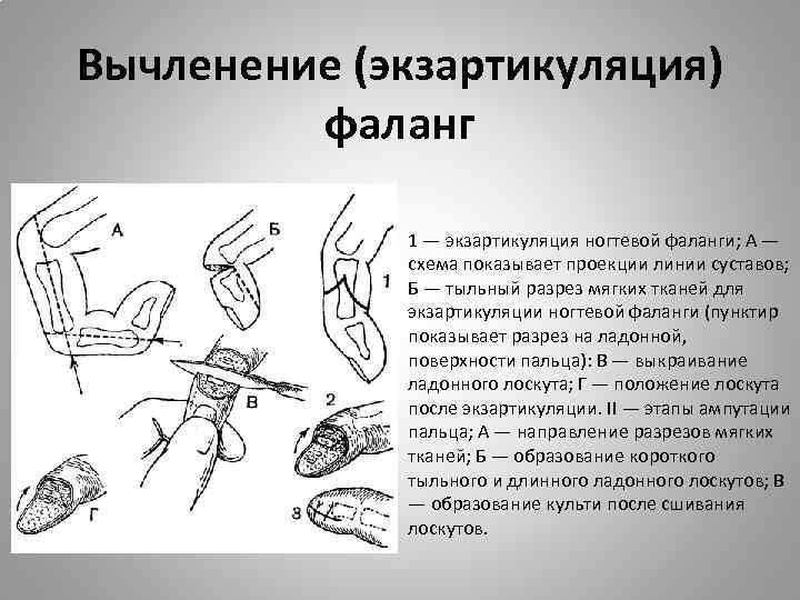 Вычленение (экзартикуляция) фаланг 1 — экзартикуляция ногтевой фаланги; А — схема показывает проекции линии