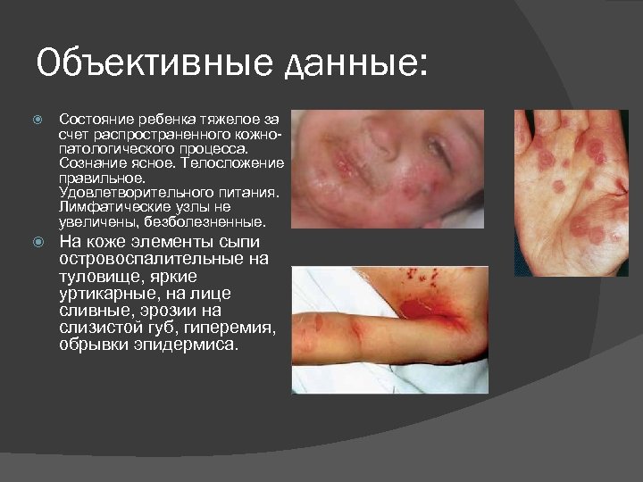 Объективные данные: Состояние ребенка тяжелое за счет распространенного кожнопатологического процесса. Сознание ясное. Телосложение правильное.