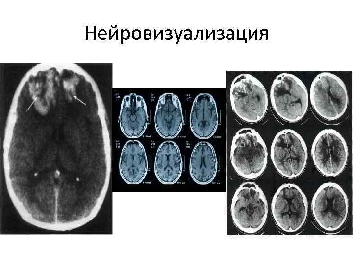 Нейровизуализация 