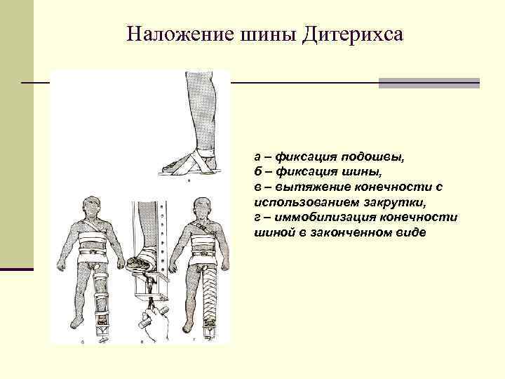 Наложение шины Дитерихса а – фиксация подошвы, б – фиксация шины, в – вытяжение