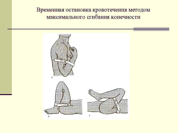 Временная остановка кровотечения методом максимального сгибания конечности 