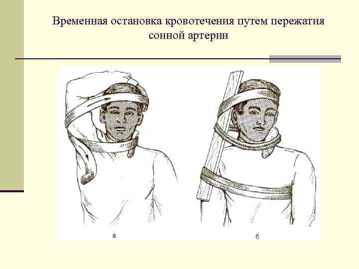 Временная остановка кровотечения путем пережатия сонной артерии 