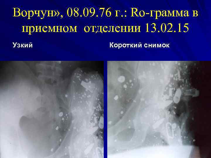 Ворчун» , 08. 09. 76 г. : Rо-грамма в приемном отделении 13. 02. 15