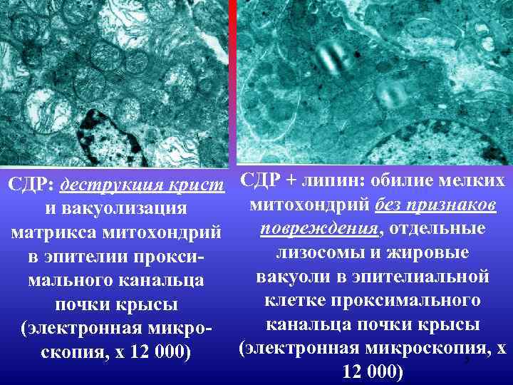 СДР: деструкция крист СДР + липин: обилие мелких митохондрий без признаков и вакуолизация повреждения,