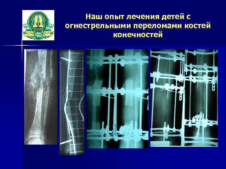 Наш опыт лечения детей с огнестрельными переломами костей конечностей 