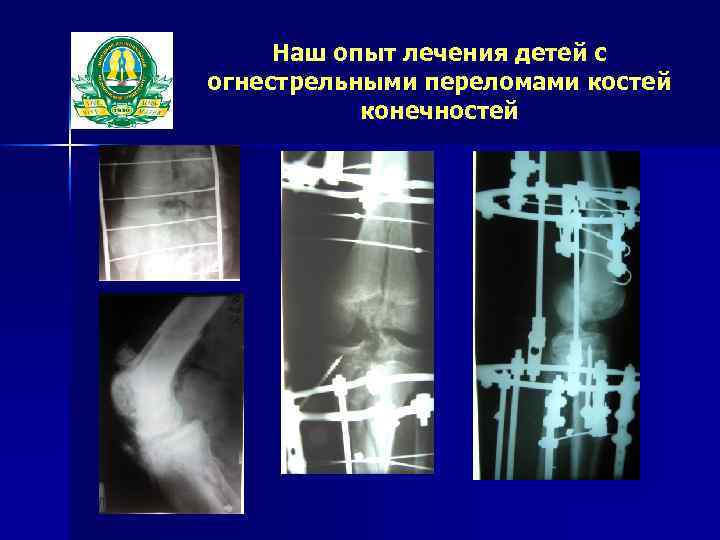 Наш опыт лечения детей с огнестрельными переломами костей конечностей 