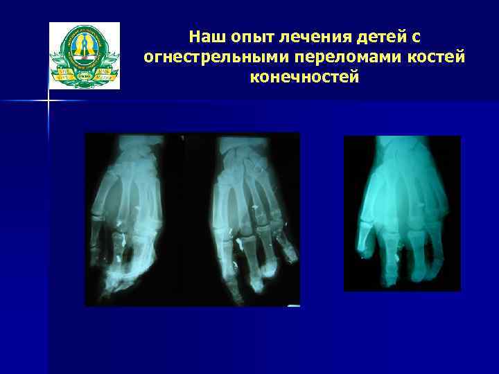 Наш опыт лечения детей с огнестрельными переломами костей конечностей 