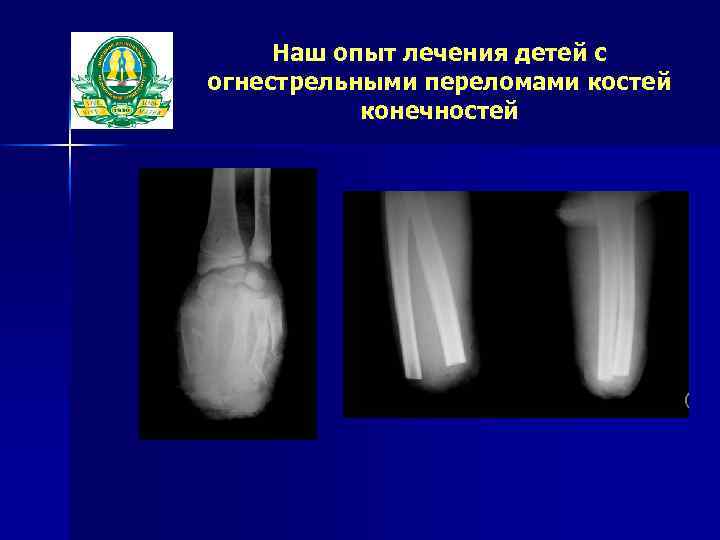 Наш опыт лечения детей с огнестрельными переломами костей конечностей 