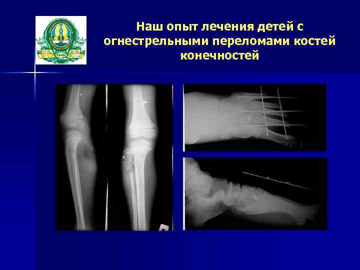 Наш опыт лечения детей с огнестрельными переломами костей конечностей 