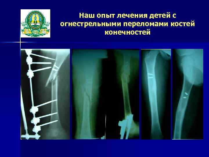 Наш опыт лечения детей с огнестрельными переломами костей конечностей 