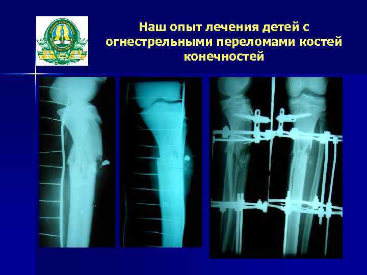 Наш опыт лечения детей с огнестрельными переломами костей конечностей 