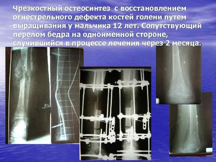 Переломы костей голени тест нмо