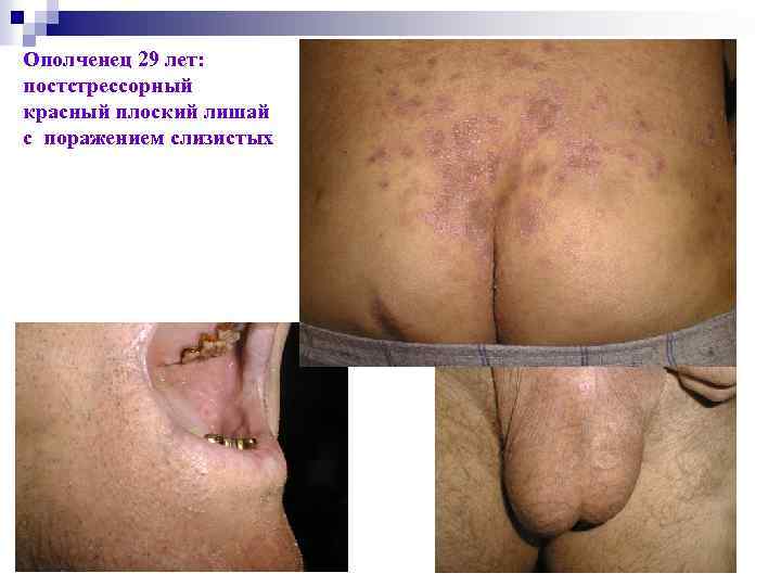 Ополченец 29 лет: постстрессорный красный плоский лишай с поражением слизистых 