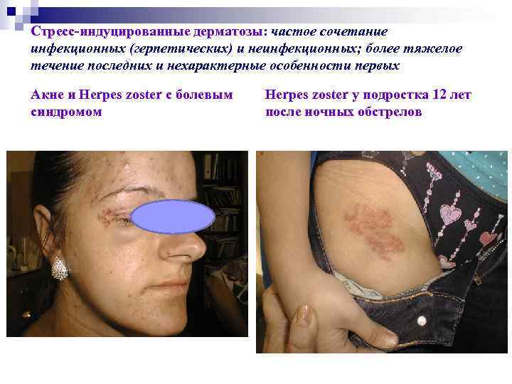 Стресс-индуцированные дерматозы: частое сочетание инфекционных (герпетических) и неинфекционных; более тяжелое течение последних и нехарактерные