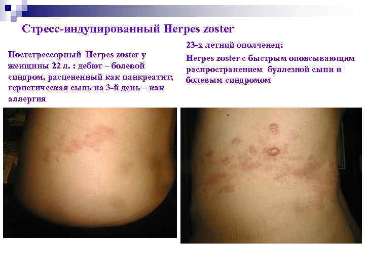 Стресс-индуцированный Herpes zoster Постстрессорный Herpes zoster у женщины 22 л. : дебют – болевой