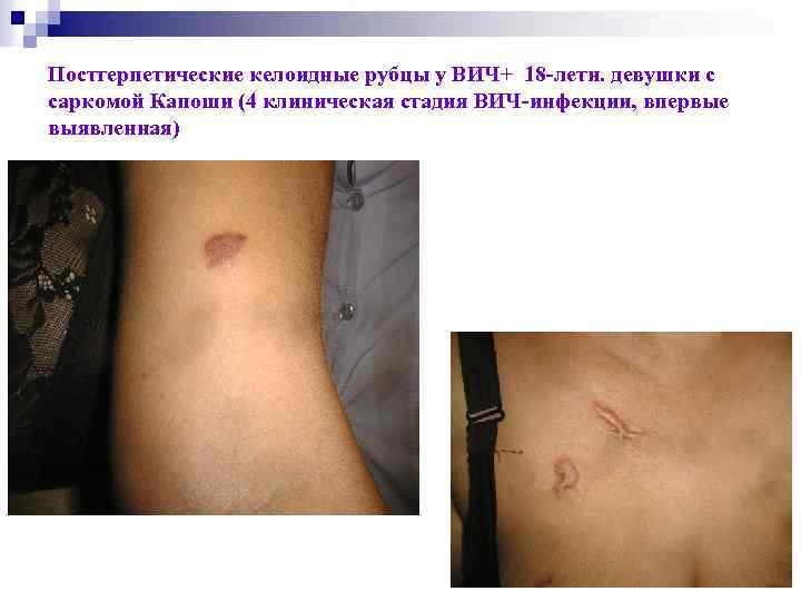Постгерпетические келоидные рубцы у ВИЧ+ 18 -летн. девушки с саркомой Капоши (4 клиническая стадия