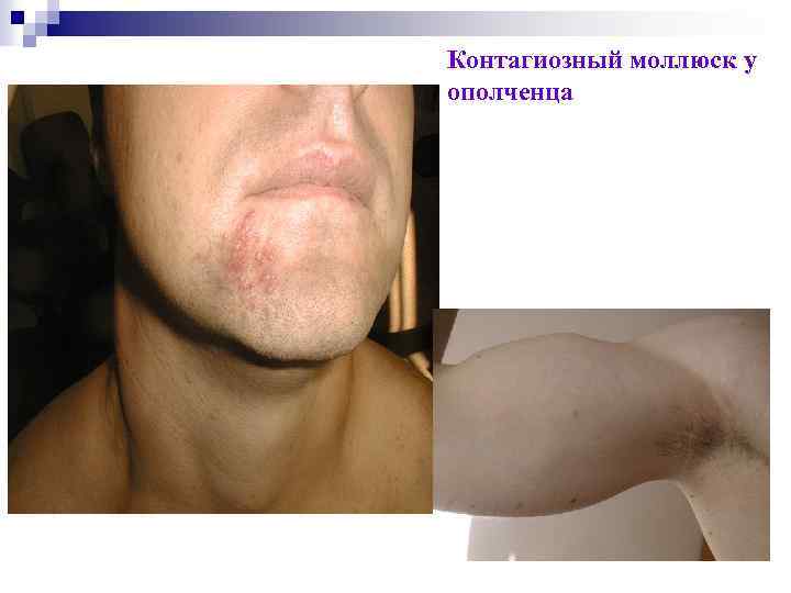 Контагиозный моллюск у ополченца 