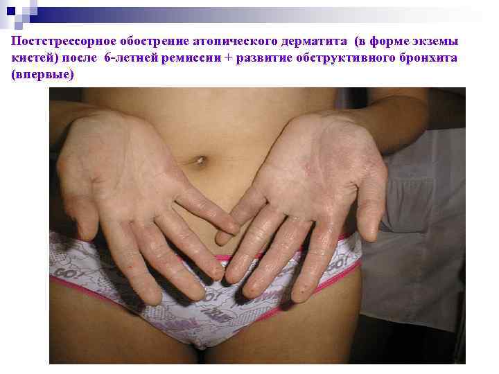 Постстрессорное обострение атопического дерматита (в форме экземы кистей) после 6 -летней ремиссии + развитие