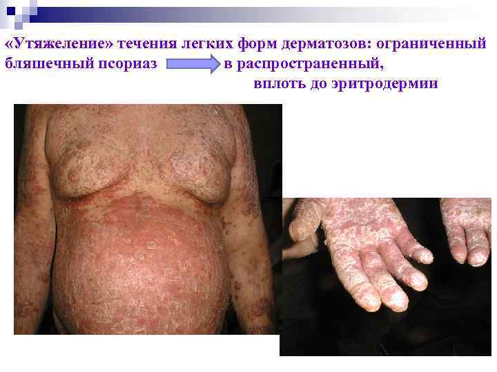  «Утяжеление» течения легких форм дерматозов: ограниченный бляшечный псориаз в распространенный, вплоть до эритродермии
