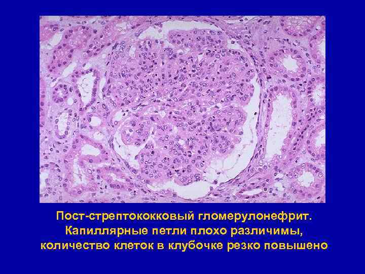 Пост-стрептококковый гломерулонефрит. Капиллярные петли плохо различимы, количество клеток в клубочке резко повышено 
