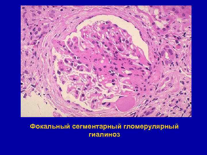 Фокальный сегментарный гломерулярный гиалиноз 