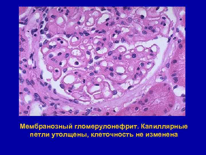 Мембранозный гломерулонефрит. Капиллярные петли утолщены, клеточность не изменена 