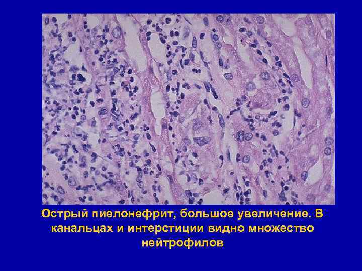 Острый пиелонефрит, большое увеличение. В канальцах и интерстиции видно множество нейтрофилов 