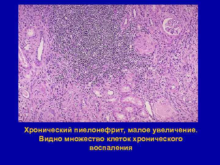 Хронический пиелонефрит, малое увеличение. Видно множество клеток хронического воспаления 