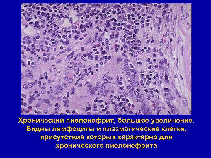 Хронический пиелонефрит, большое увеличение. Видны лимфоциты и плазматические клетки, присутствие которых характерно для хронического