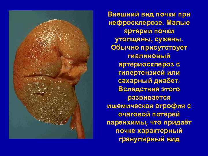 Внешний вид почки при нефросклерозе. Малые артерии почки утолщены, сужены. Обычно присутствует гиалиновый артериосклероз