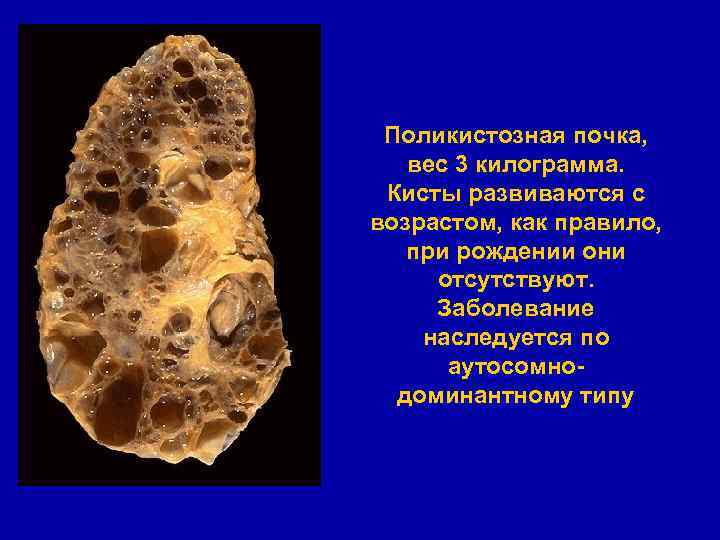 Поликистозная почка, вес 3 килограмма. Кисты развиваются с возрастом, как правило, при рождении они