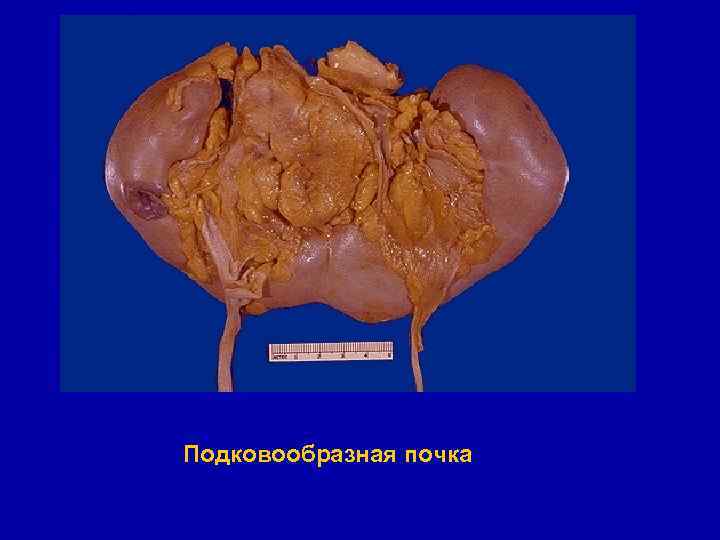 Подковообразная почка 