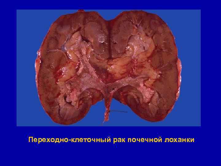 Переходно-клеточный рак почечной лоханки 