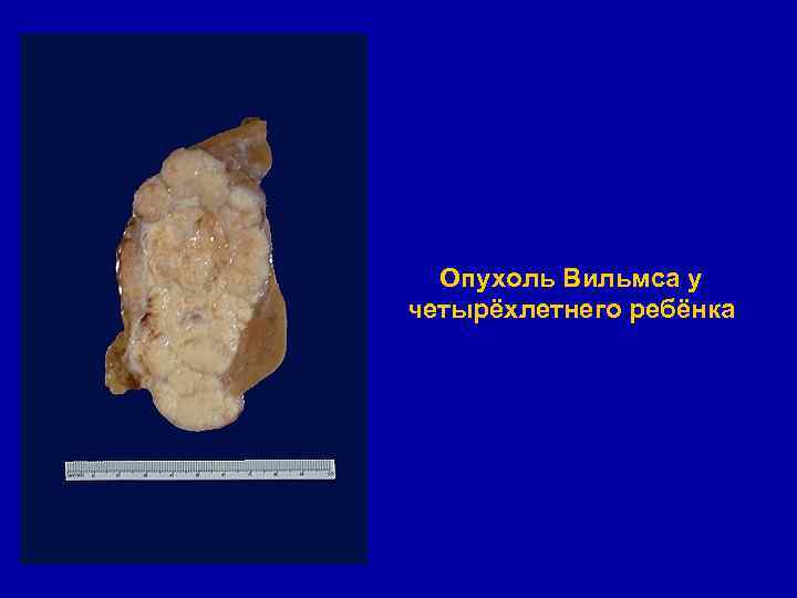 Опухоль Вильмса у четырёхлетнего ребёнка 
