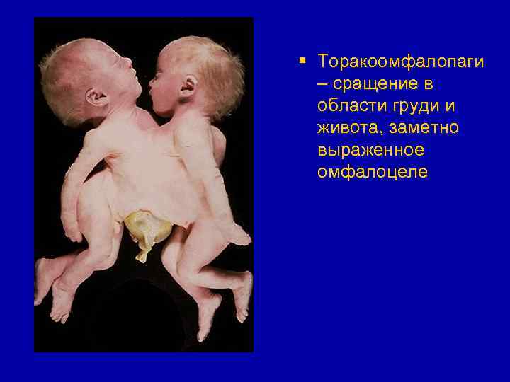 § Торакоомфалопаги – сращение в области груди и живота, заметно выраженное омфалоцеле 