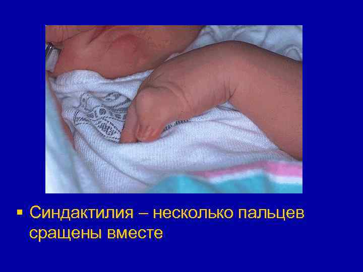 § Синдактилия – несколько пальцев сращены вместе 