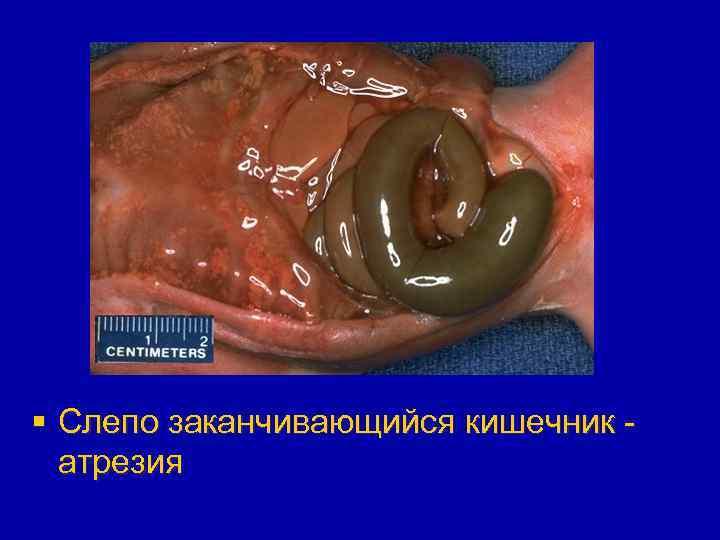 § Слепо заканчивающийся кишечник атрезия 
