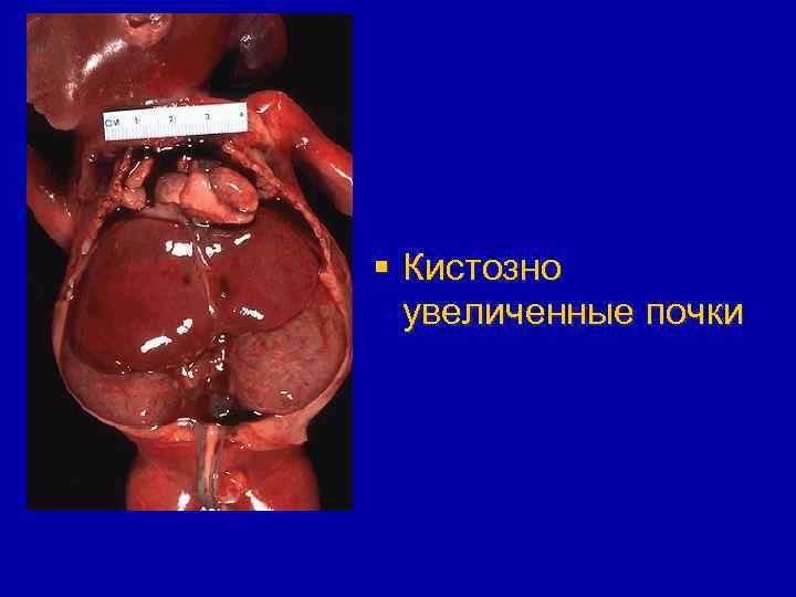 § Кистозно увеличенные почки 