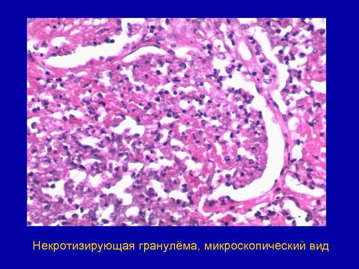 Некротизирующая гранулёма, микроскопический вид 