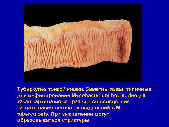 Туберкулёз тонкой кишки. Заметны язвы, типичные для инфицирования Mycobacterium bovis. Иногда такая картина может