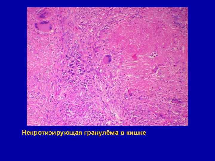 Некротизирующая гранулёма в кишке 