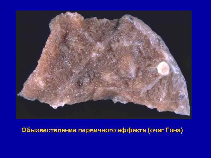 Обызвествление первичного аффекта (очаг Гона) 