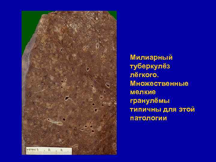 Милиарный туберкулёз лёгкого. Множественные мелкие гранулёмы типичны для этой патологии 