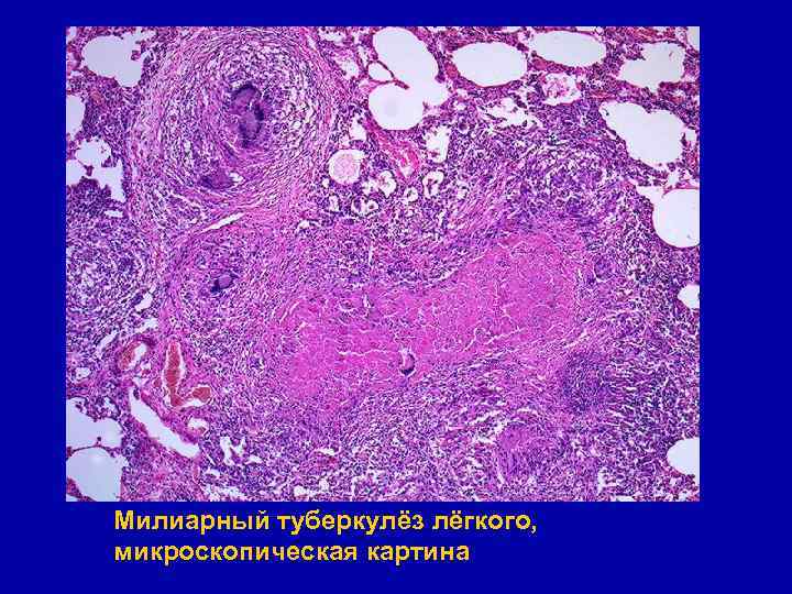 Милиарный туберкулёз лёгкого, микроскопическая картина 