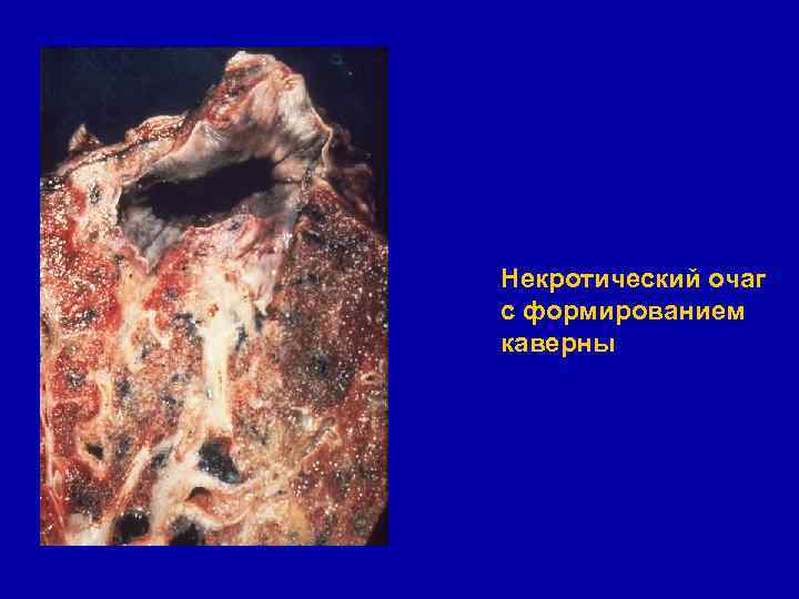 Некротический очаг с формированием каверны 