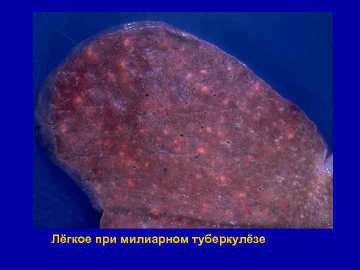 Лёгкое при милиарном туберкулёзе 