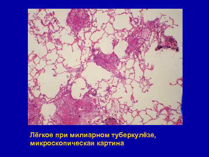 Лёгкое при милиарном туберкулёзе, микроскопическая картина 