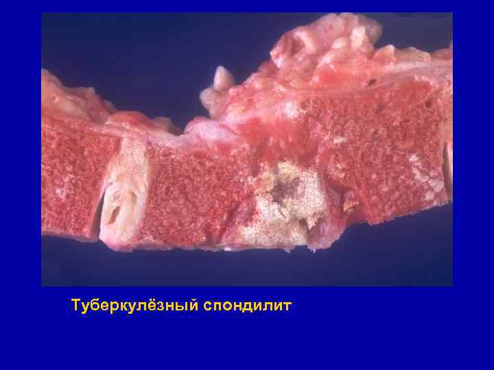 Туберкулёзный спондилит 