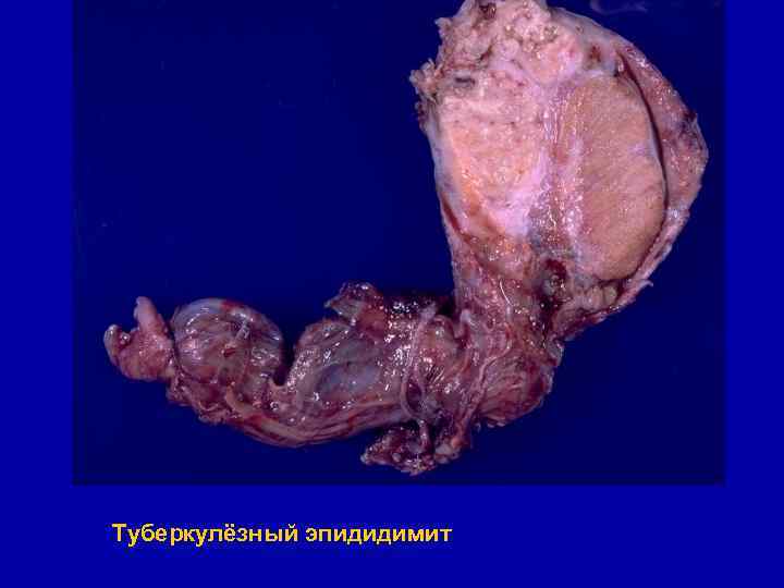 Туберкулёзный эпидидимит 